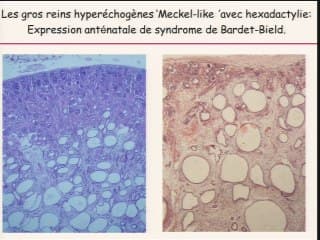 Quelle est la place de la foetopathologie dans les maladies rénales prénatales ?