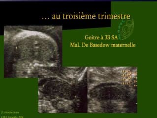 Goitre foetal sirenomelie