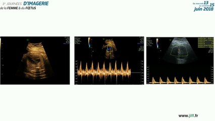 fibrosarcome infantile congenital