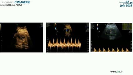 fibrosarcome infantile congenital