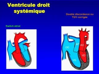 Devenir à l’âge adulte des malformations cardiaques congénitales. Désir de grossesse chez une patiente porteuse d’une malformation cardiaque congénitale