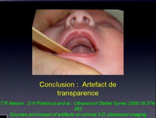Artéfact de transparence palatin