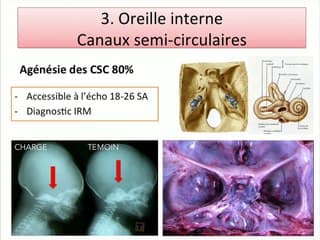 De la petite cardiopathie au gros syndrome CHARGE