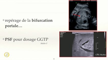 La vésicule biliaire : simple virgule ou source d'ennuis ?