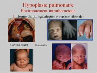 Hypoplasie et agénésie pulmonaire Environnement et génétique
