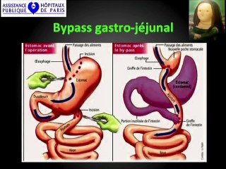 Obésité et diagnostic anténatal : Chirurgie bariatique