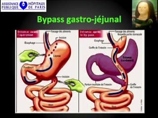 Obésité et diagnostic anténatal : Chirurgie bariatique