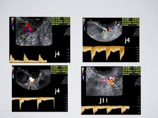Faut-il faire les Dopplers des artères utérines dans le bilan d’infertilité.
