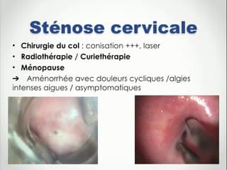 Hématométrie : que rechercher ?