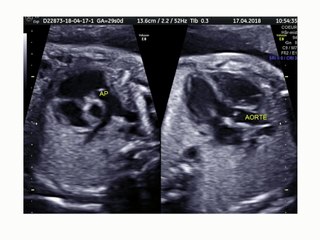Diagnostic et prise en charge des troubles du rythmes fœtaux