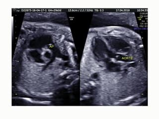 Diagnostic et prise en charge des troubles du rythmes fœtaux