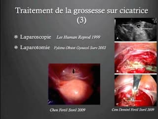 Echographie gynécologique au 1er trimestre de la grossesse: Que découvrir sur signes d'appel