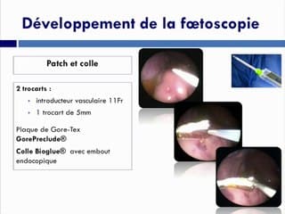 RÉPARATION ANTÉNATALE DES MYÉLOMÉNINGOCÈLES : LIMITES ACTUELLES ET PERSPECTIVES