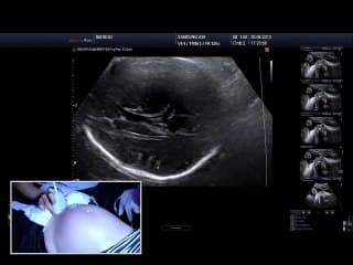 Live: Optimiser l'examen ducerveau au 3ème trimestre : noyaux centraux, giration?