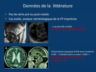 Kyste rétrocérébelleux et hétérotopies périventriculaires