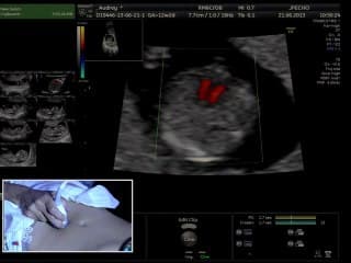 Live: Morphologie au 1er trimestre