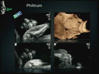 Insuffisances, incertitudes, difficultés, piéges et erreurs de l'imagerie anténatale La face.