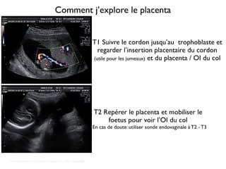 POSTER Placenta