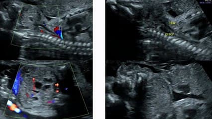 Tératome cervical géant