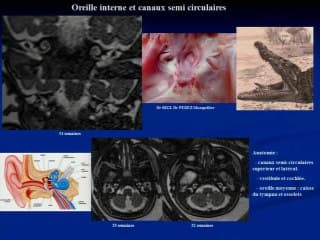 Le syndrome de CHARGE Le diagnostic foetal : pourquoi c'est difficile.