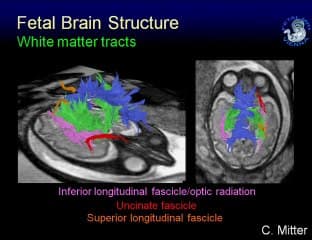 tehcniques IRM pour l' étude du cerveau foetal  ( en ANGLAIS )