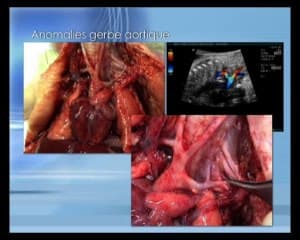 Trisomie1 monosomie 3 dysplasie renale