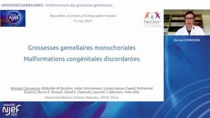 Malformations des grossesses gémellaires