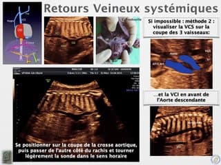 POSTER Retours veineux caves et pulmonaires
