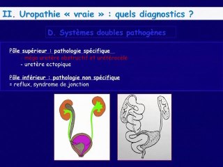 Dilatation des cavités rénales