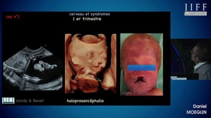 Quiz de syndromique et erreurs d'experts Imagerie du cerveau