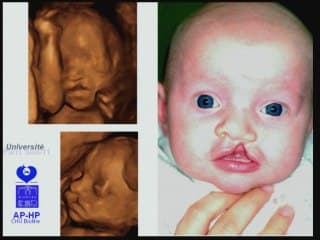 chirurgie des fentes précoces ou non ?