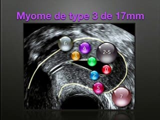 Urgences en gynécologie  ? Les images a_ connaître absolument !