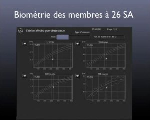 Ostéogenèse imparfaite