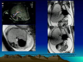 Emphysème pulmonaire foetal : synthèse.