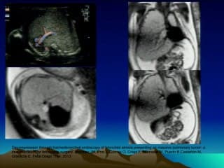 Emphysème pulmonaire foetal : synthèse.