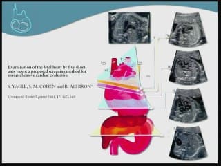 échographie du coeur