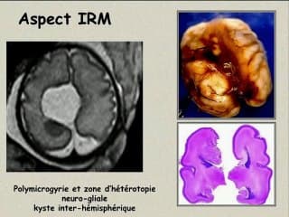Polymicrogyrie et polymicrogyries