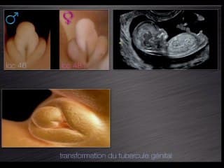 Éléments d’embryologie de l’appareil urinaire. Malformations des voies urinaires. Aspect écho-embryologique normal et pathologique au 1er trimestre entre 9 SA et 12 SA