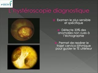 LE TRANSFERT EMBRYONNAIRE SOUS ÉCHOGRAPHIE La négociation du canal cervical