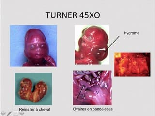 Coeur : foetopathologie Quand, comment, pourquoi examiner les valves cardiaques ?