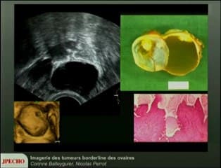 Tumeur borderline de l'ovaire
