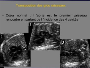 La TGV transposition des gros vaisseaux, le diagnostic à ne pas manquer