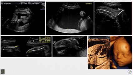 Coeur foetal - Les pathologies cono-troncales