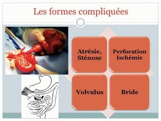 Quels sont les facteurs échographiques anténataux prédictifs de laparoschisis compliqués