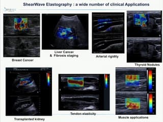 imagerie ultra sonore ultra rapide
