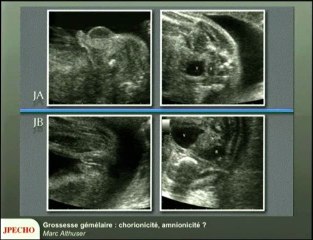 Grossesse gémellaire : chorionicité, amnionicité ?