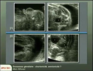 Grossesse gémellaire : chorionicité, amnionicité ?