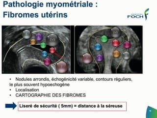 L’utérus, dépistage classique par l’échographie : fibrome, polype