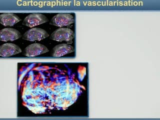 Fibromes : nouvelles stratégies L'imagerie après traitement : échographie apres smya