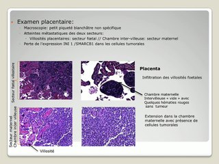 Tumeur rhabdoïde congénitale disséminée et atteinte placentaire: à propos d’un cas.